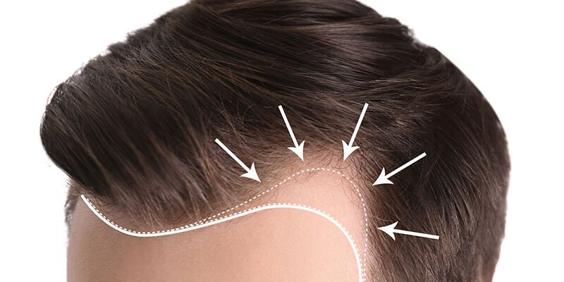 أفضل مراكز لزراعة الشعر في مصر.. وتكلفة العملية