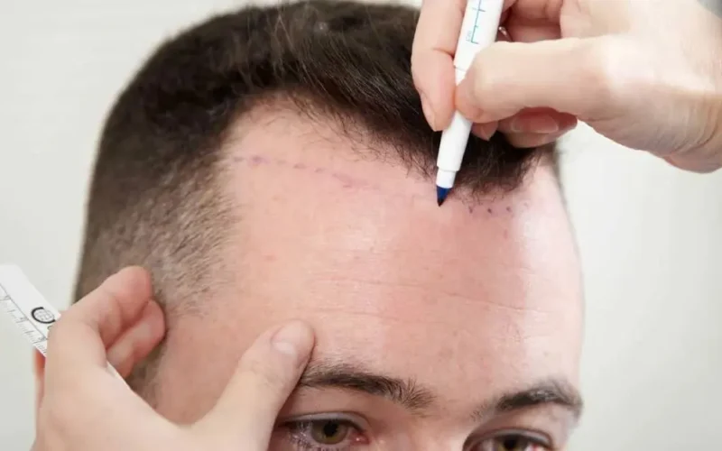 أسعار زراعة الشعر في مصر والسعودية وتركيا 2024